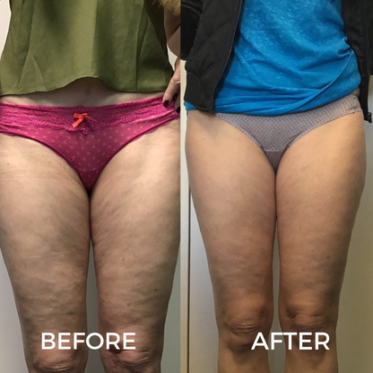 BodySculpt Pro™ System